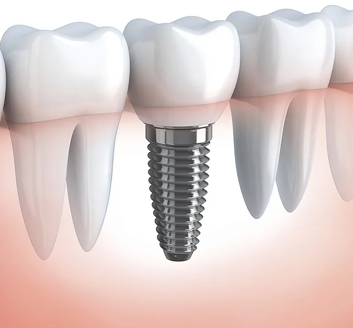 Dental implant consultation at Divine Dental Care Croydon